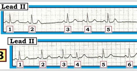 Interpret The Two Sequential Tracings In Figure The Patient Is