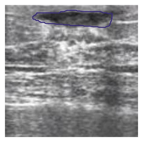 Image cutting of benign breast tumor. (a) Original picture. (b) Elawady ...