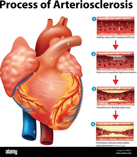 Proceso De Arteriosclerosis Imagen Vector De Stock Alamy