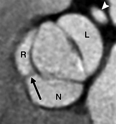 Bicuspid Aortic Valve Spectrum Of Imaging Findings At Cardiac Mdct And Cardiovascular Mri Ajr