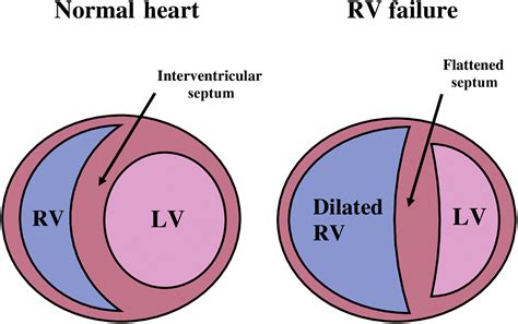 The right ventricle—structural and functional importance for ...