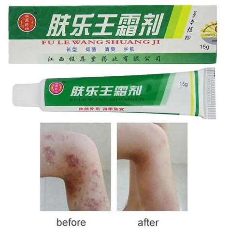 Herbal Material Psoriasis Creams Dermatitis And Eczema Pruritus