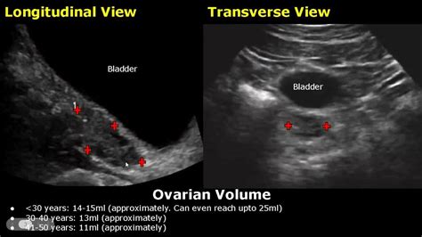 How To Measure Ovarian Volume Ultrasound | Ovary Length, Width, Depth Measurements TAS/TVS Views ...