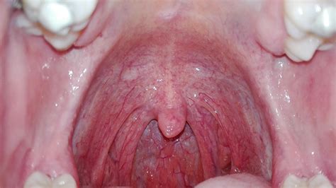 The small white lump on the roof of my mouth and cobblestone throat are both problems over a ...