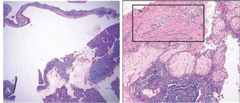 Mature Cystic Teratoma Of The Pancreas A Rare Cystic Neoplasm