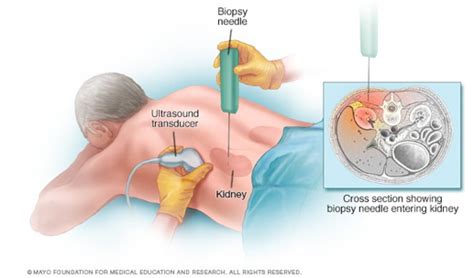 Can a biopsy spread cancer? - Geistek Pharma