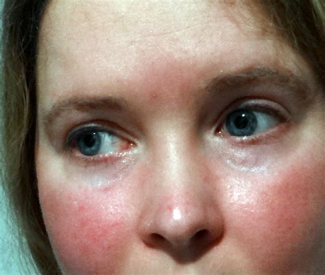 Scarlet Letters Dealing With Vascular Rosacea Face Flushing Burning And The Rest Do I Have