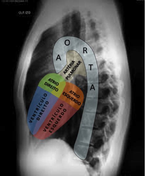 Você Sabe Interpretar Uma Radiografia De Tórax Da Forma Certa