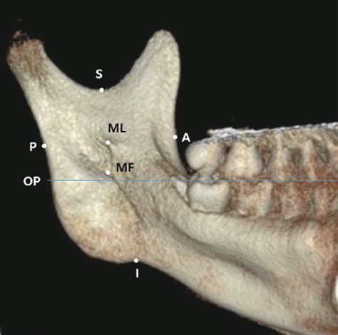 Figure 1 From Assessment Of The Position Of The Mandibular Foramen And