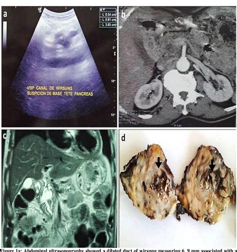 Figure 1 From MALIGNANT TRANSFORMATION OF INTRADUCTAL PAPILLARY