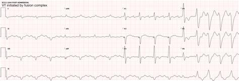 Differential Diagnosis Of Nonsustained Ventricular Tachycardia