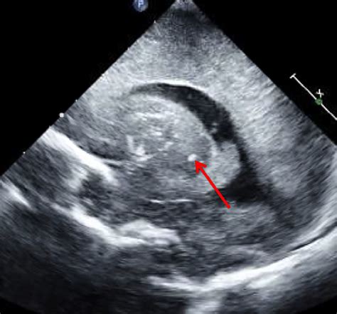 Sagittal View Of The Neonatal Cranial Ultrasound Showing Ventricular Download Scientific