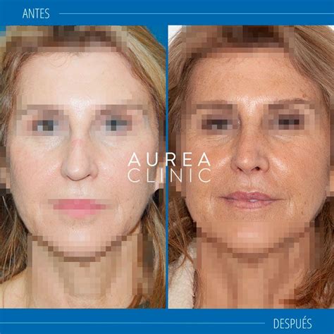 Rinoplastia Sevilla Para Tu Operaci N De Nariz Aurea Clinic