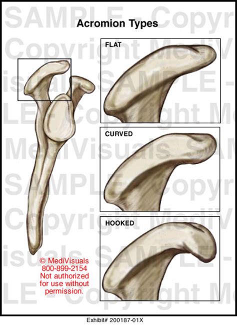 Acromion Types Medical Illustration Medivisuals