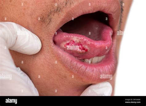 Squamous Cell Carcinoma Of Tongue Oral Cancer Or Malignant Tumor Of