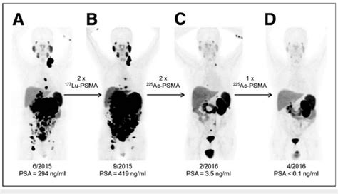 Efficacy Of 225actinium Prostate Specific Membrane Antigen 68 Download Scientific Diagram