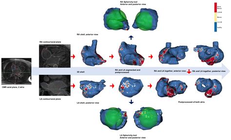 Progressive And Simultaneous Right And Left Atrial Remodeling Uncovered