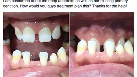 Jaw Surgery Vs All On 4 For Missing Teeth And Cl3 Skeletal Dr Alex