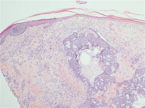 Clay J Cockerell M D Importance Of Histopathology In Cutaneous