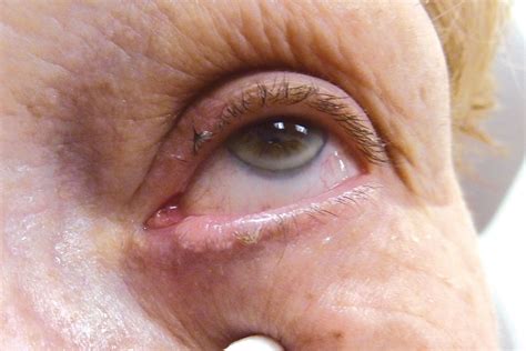 Sebaceous Cell Carcinoma Eyelid