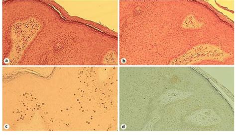 Histological Evaluation Of The Lesions A Hematoxylin And Eosin