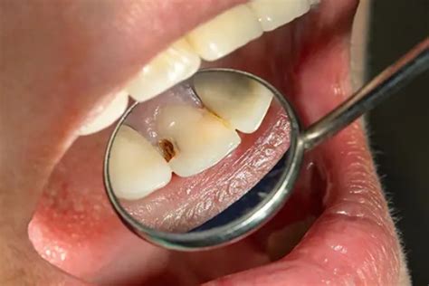 Claves Para Prevenir La Caries En Los Ni Os Blog Dentista En Tu Ciudad