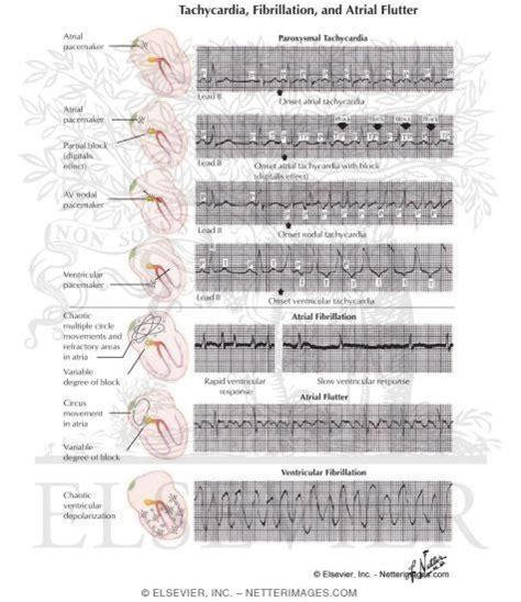 Cardiac Arrhythmia Cardiac Arrhythmias General Atrial Flutter