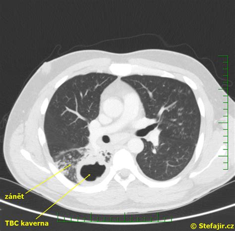 N Lez Plicn Tuberkul Za Medic Na Nemoci Studium Na Lf Uk