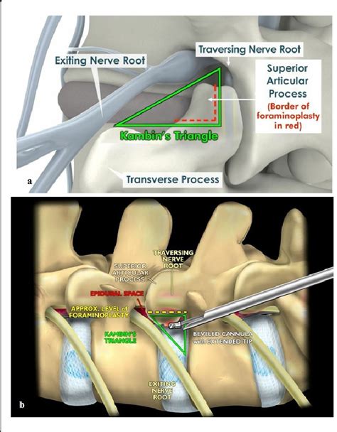 The Yeung Percutaneous Endoscopic Lumbar Decompressive Technique Yess