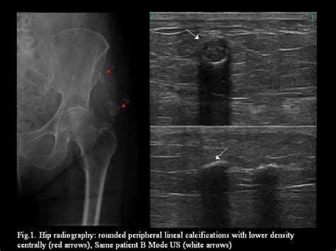 BENIGN LESIONS OF THE SUBCUTANEOUS SOFT TISSUE WITH CALCIFICATIONS