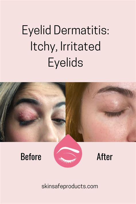 Simple home remedies for dry flaky eyelids – Artofit