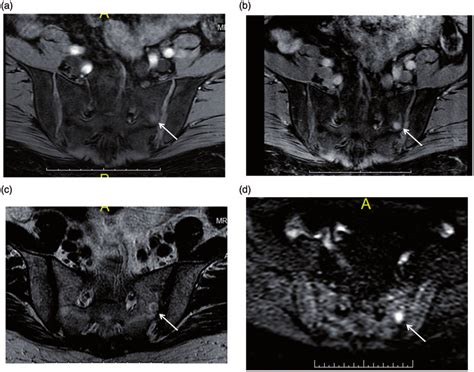 Pelvic Mr Exam Axial Pre Contrast A And Post Contrast B T1w Mr