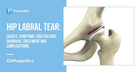 Hip Labral Tear Causes Symptoms Risk Factors Diagnosis Treatment