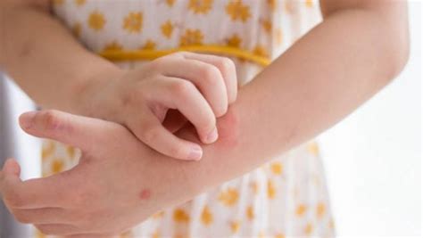 Urticaria En Niños Causas Síntomas Tratamiento Y Complicaciones