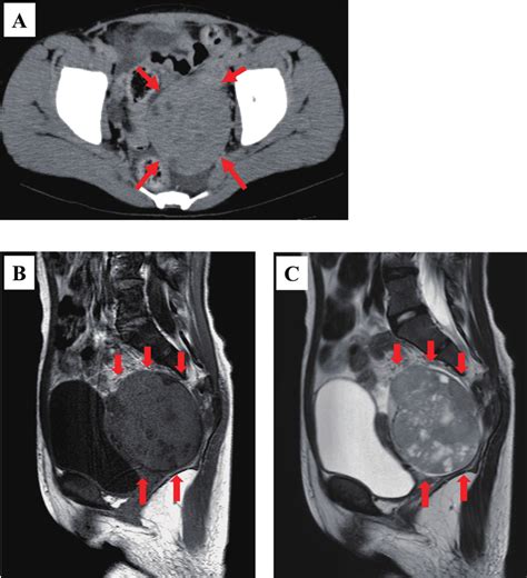 Imaging Of The Tumor A B And C Are Plane Ct Mri T1 Weighted Image