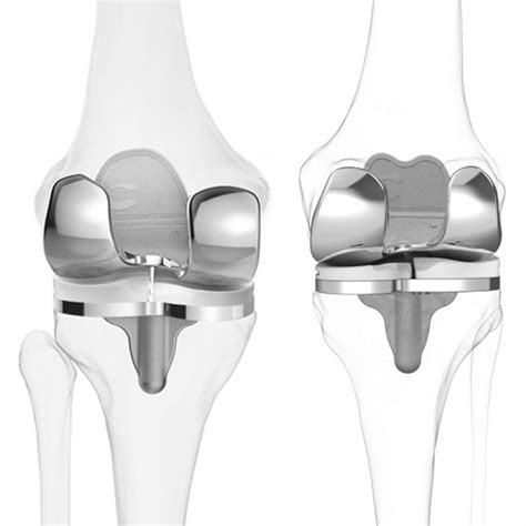 Conformis Ipo For 3d Printed Knees 3d Printing Industry