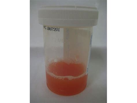 Synovial Fluid Analysis of Ankle Joint