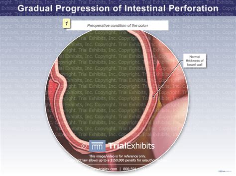 Gradual Progression of Intestinal Perforation: Preoperative Condi...