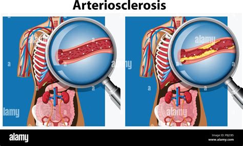 Anatom A Humana Con La Arteriosclerosis Ilustraci N Imagen Vector De