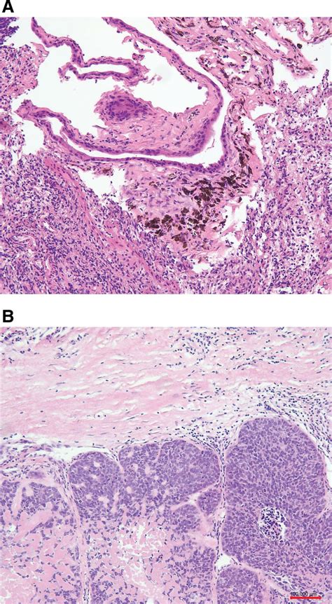 Squamous Cell Carcinoma In Mature Cystic Teratoma Of The Ova Medicine