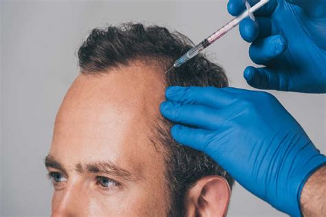 Mesotherapy For Hair Loss And Hair Growth Dhi Mexico