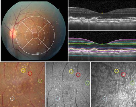 Imaging in Retinal Diseases