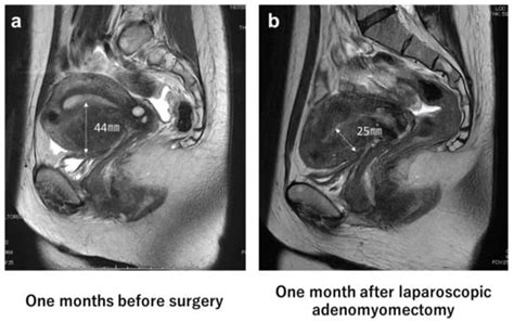 JCM Free Full Text Laparoscopic Adenomyomectomy Under Real Time