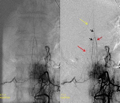 Anterior Spinal Artery Angiogram