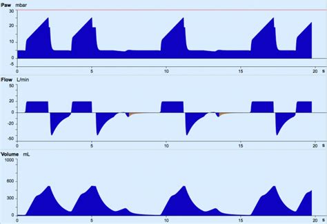 Ventilator Dyssynchrony - Neuroresus