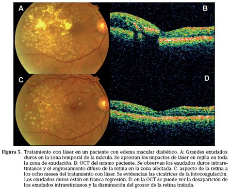 Edema Macular Diab Tico