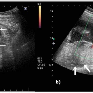 Gray Scale And Colour Doppler Ultrasonography Us Reveals Dilated