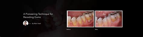 Surrey Pinhole Surgery Technique For Gum Recession Treatment