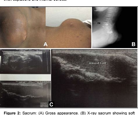 Figure From Ultrasonographic Diagnosis Of Tumoral Calcinosis In End