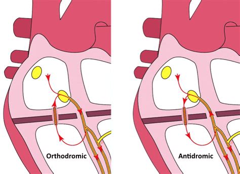 Atrioventricular Re Entry Tachycardia AVRT LITFL ECG Library